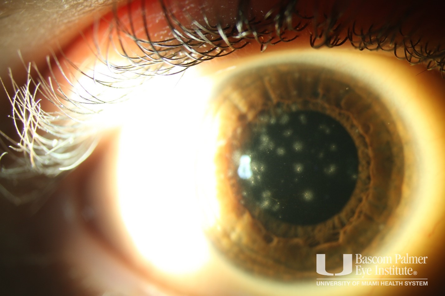 rs051823oi-recurrent-subepithelial-infiltrates-following-epidemic
